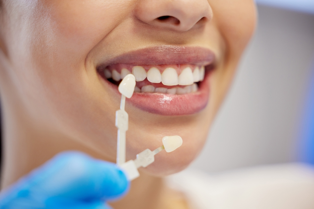 Dental Veneers Highland Park
